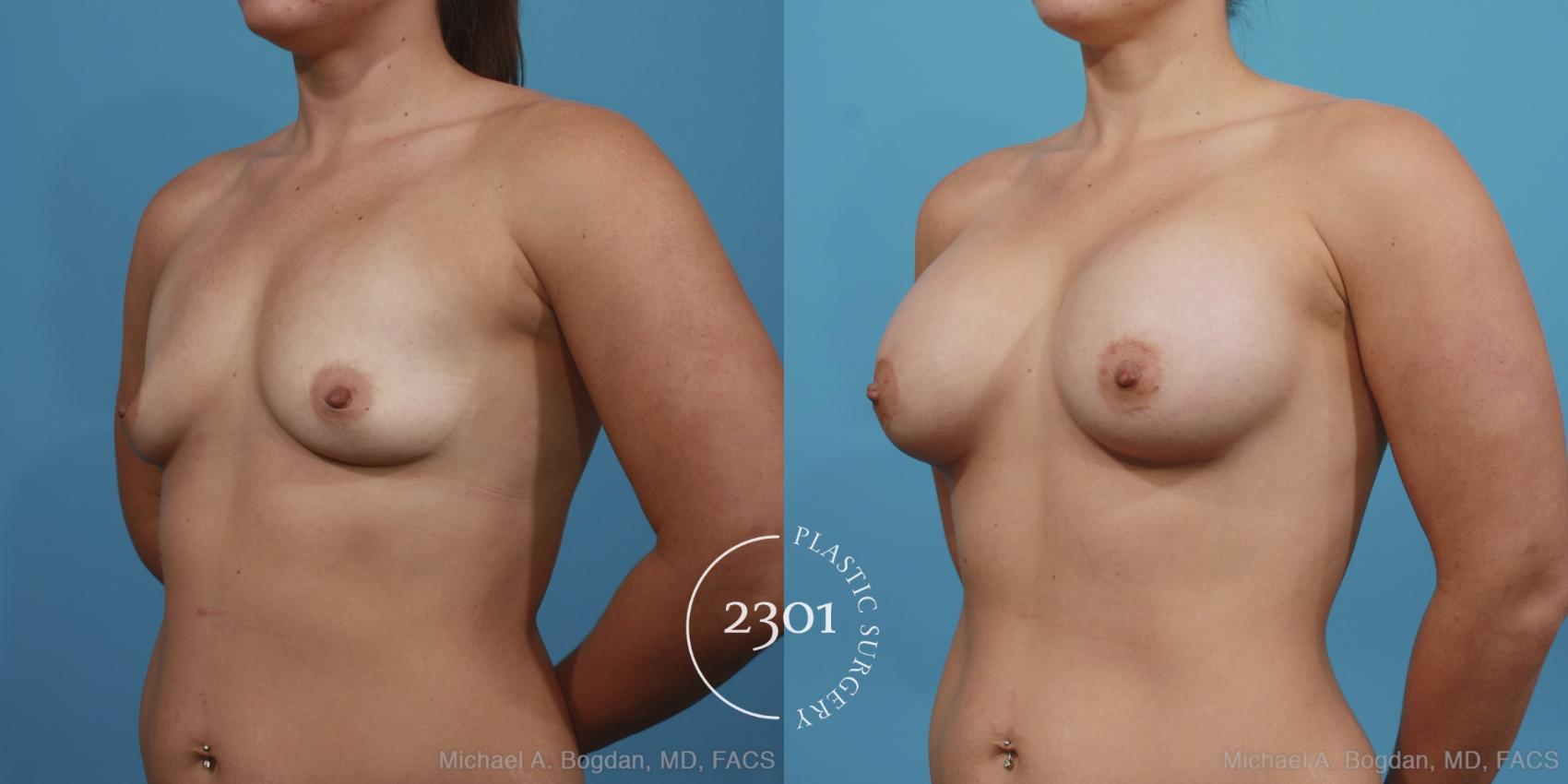 Before & After Silicone Implants Case 401 View #3 View in Fort Worth, Plano, & Frisco, Texas