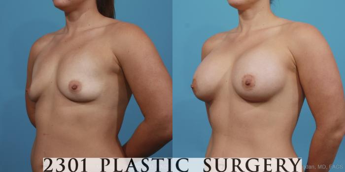 Before & After Silicone Implants Case 401 View #3 View in Fort Worth, Plano, & Frisco, Texas