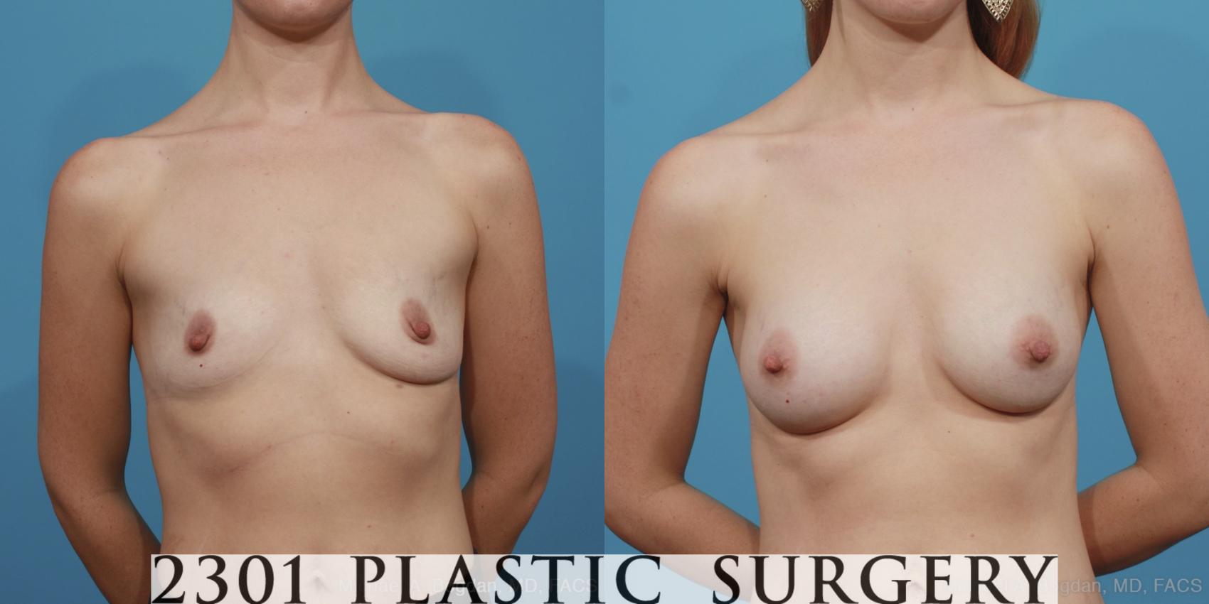 Before & After Silicone Implants Case 403 View #1 View in Fort Worth, Plano, & Frisco, Texas
