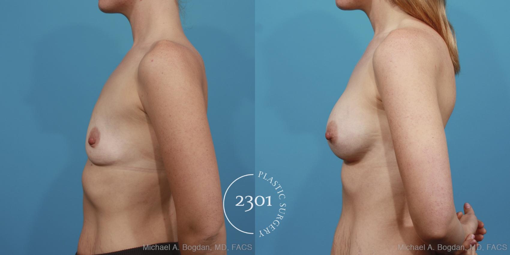 Before & After Silicone Implants Case 403 View #2 View in Fort Worth, Plano, & Frisco, Texas