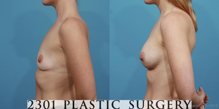 Before & After Silicone Implants Case 403 View #2 View in Fort Worth, Plano, & Frisco, Texas