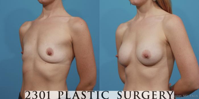 Before & After Silicone Implants Case 403 View #3 View in Fort Worth, Plano, & Frisco, Texas