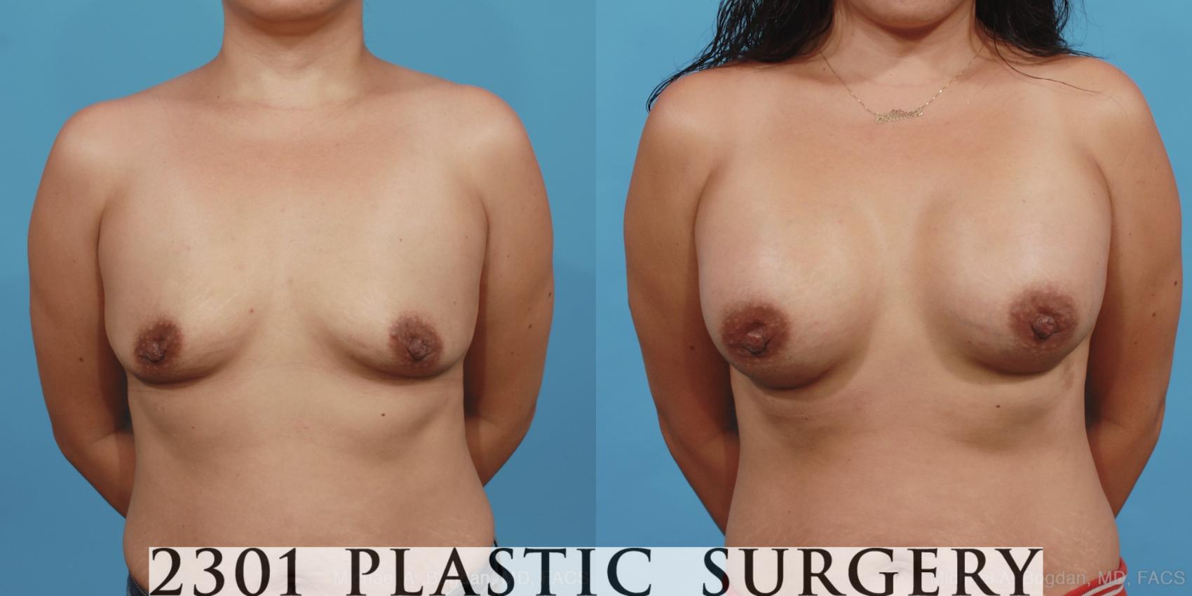Before & After Silicone Implants Case 409 View #1 View in Fort Worth, Plano, & Frisco, Texas