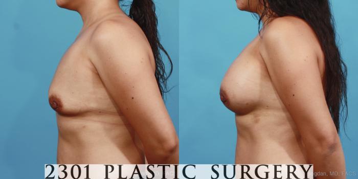 Before & After Silicone Implants Case 409 View #2 View in Fort Worth, Plano, & Frisco, Texas