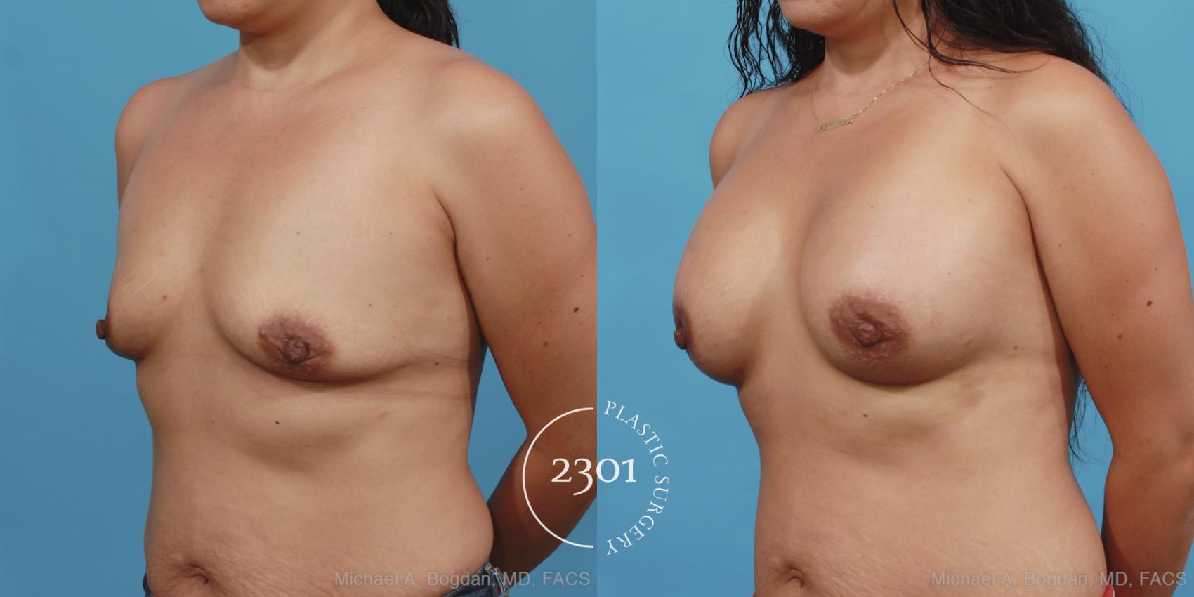 Before & After Silicone Implants Case 409 View #3 View in Fort Worth, Plano, & Frisco, Texas