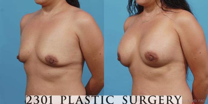 Before & After Silicone Implants Case 409 View #3 View in Fort Worth, Plano, & Frisco, Texas