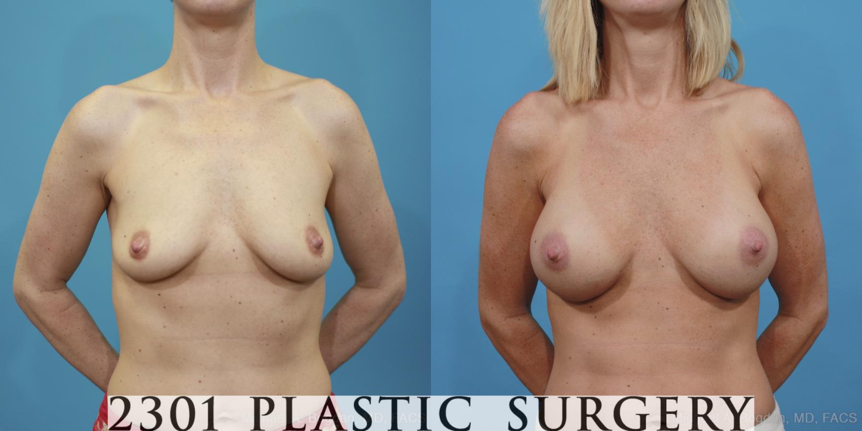Before & After Breast Augmentation Case 410 View #1 View in Fort Worth, Plano, & Frisco, Texas