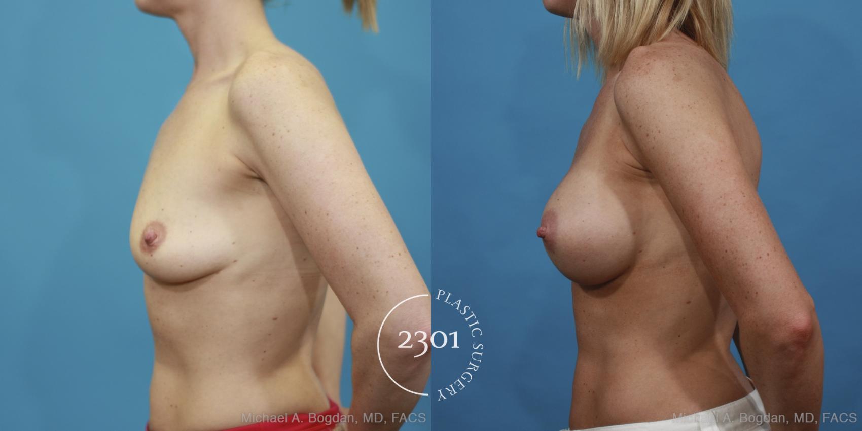 Before & After Silicone Implants Case 410 View #2 View in Fort Worth, Plano, & Frisco, Texas
