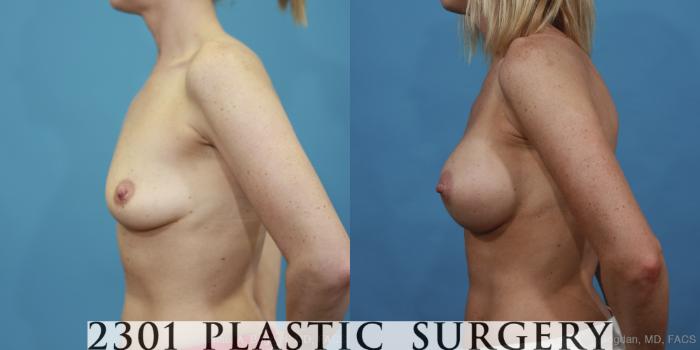 Before & After Silicone Implants Case 410 View #2 View in Fort Worth, Plano, & Frisco, Texas