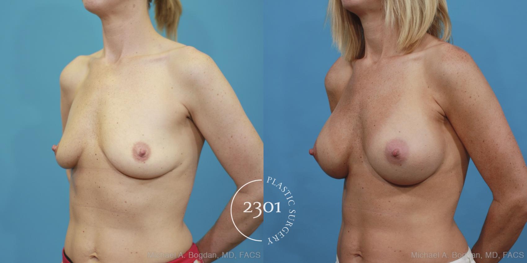 Before & After Silicone Implants Case 410 View #3 View in Fort Worth, Plano, & Frisco, Texas