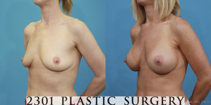 Before & After Breast Augmentation Case 410 View #3 View in Fort Worth, Plano, & Frisco, Texas