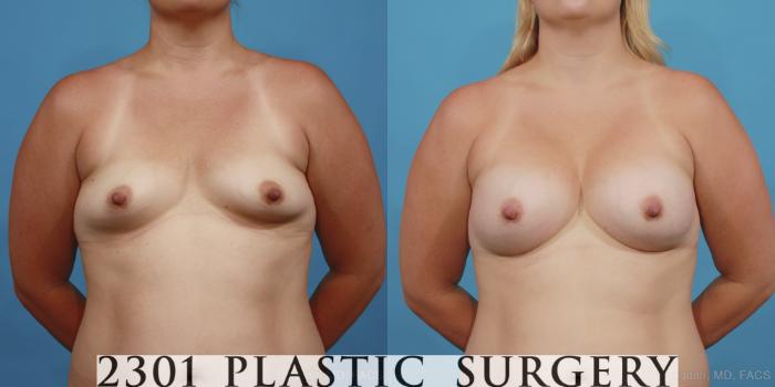 Before & After Silicone Implants Case 414 View #1 View in Fort Worth, Plano, & Frisco, Texas