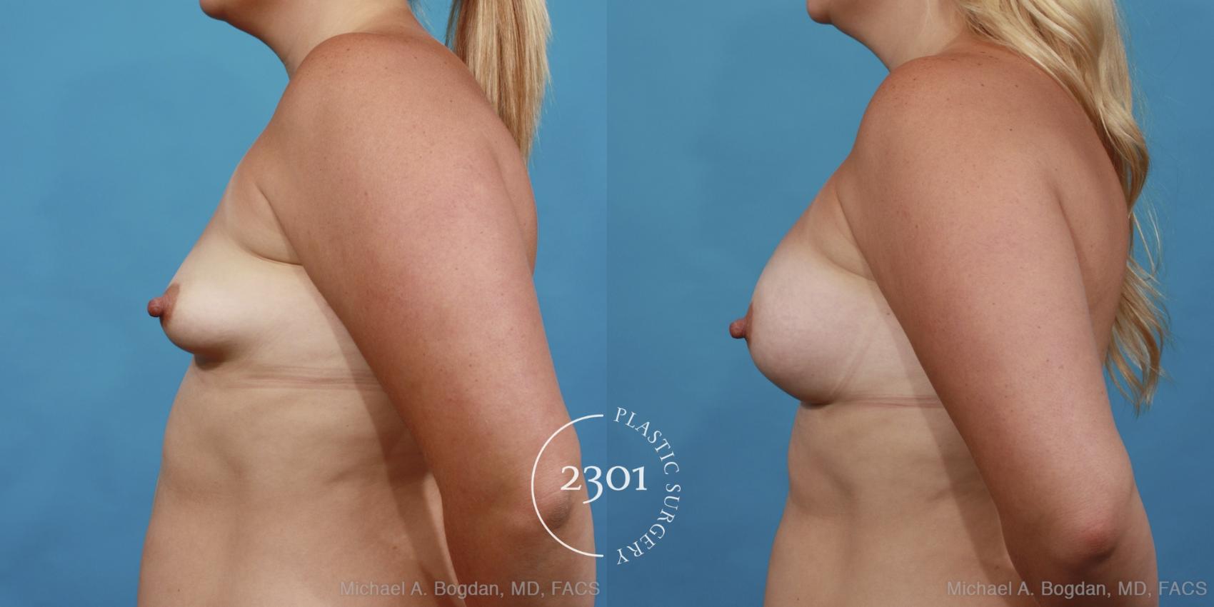 Before & After Breast Augmentation Case 414 View #2 View in Fort Worth, Plano, & Frisco, Texas