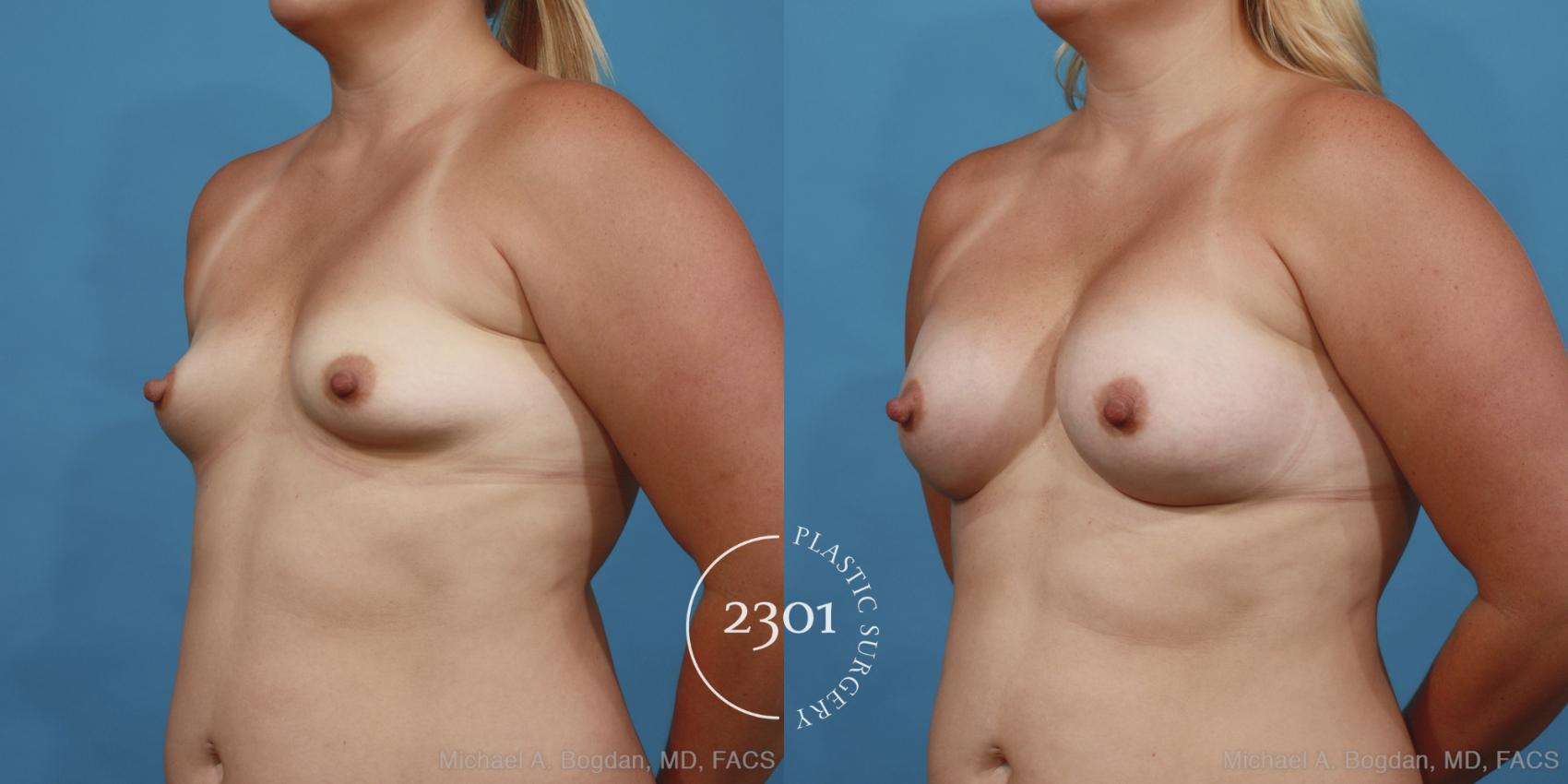 Before & After Breast Augmentation Case 414 View #3 View in Fort Worth, Plano, & Frisco, Texas