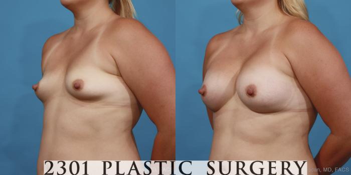 Before & After Silicone Implants Case 414 View #3 View in Fort Worth, Plano, & Frisco, Texas