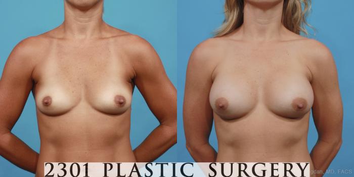 Before & After Silicone Implants Case 428 View #1 View in Fort Worth, Plano, & Frisco, Texas