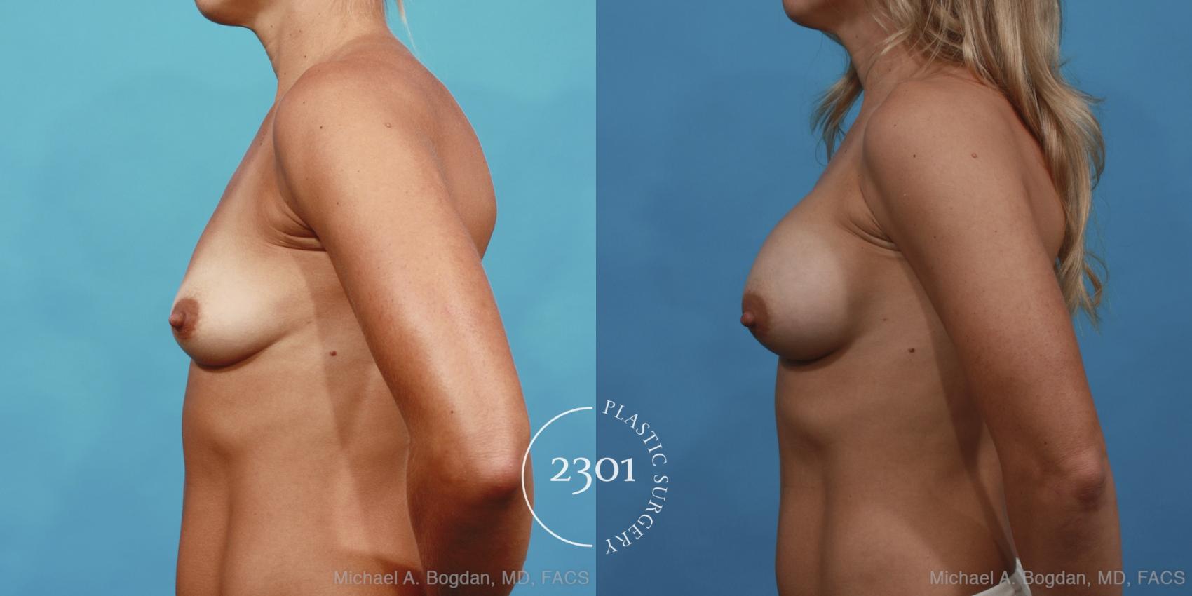 Before & After Breast Augmentation Case 428 View #2 View in Fort Worth, Plano, & Frisco, Texas