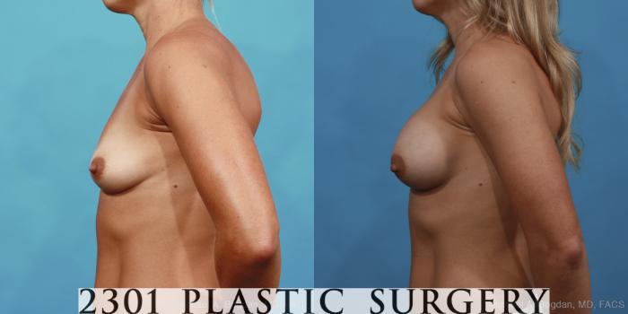 Before & After Silicone Implants Case 428 View #2 View in Fort Worth, Plano, & Frisco, Texas