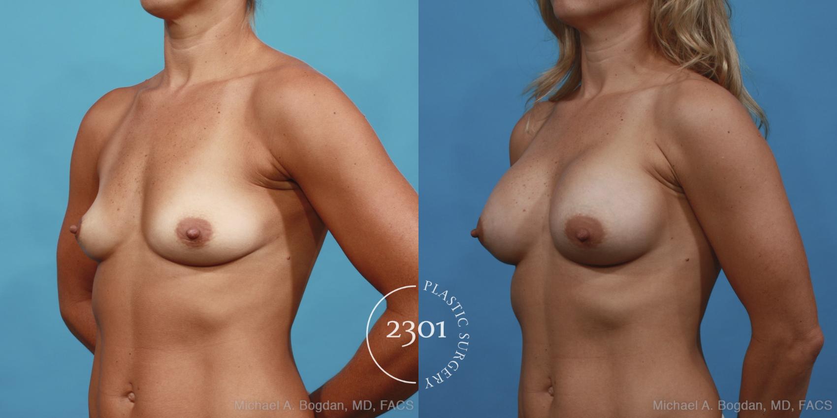 Before & After Breast Augmentation Case 428 View #3 View in Fort Worth, Plano, & Frisco, Texas