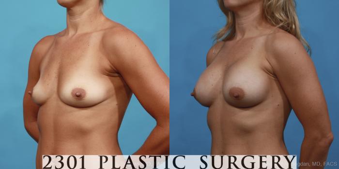 Before & After Breast Augmentation Case 428 View #3 View in Fort Worth, Plano, & Frisco, Texas