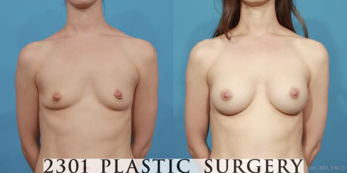 Before & After Silicone Implants Case 441 View #1 View in Fort Worth, Plano, & Frisco, Texas