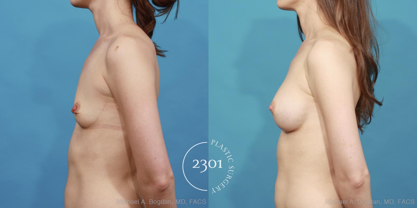 Before & After Silicone Implants Case 441 View #2 View in Fort Worth, Plano, & Frisco, Texas