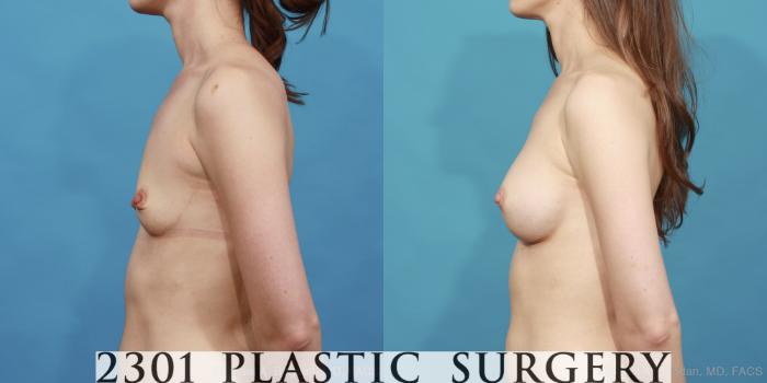Before & After Silicone Implants Case 441 View #2 View in Fort Worth, Plano, & Frisco, Texas