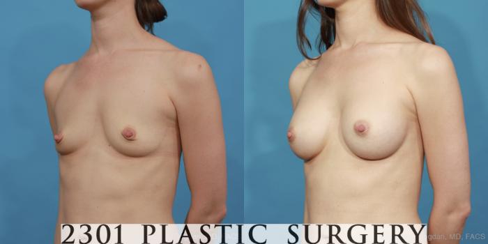 Before & After Silicone Implants Case 441 View #3 View in Fort Worth, Plano, & Frisco, Texas