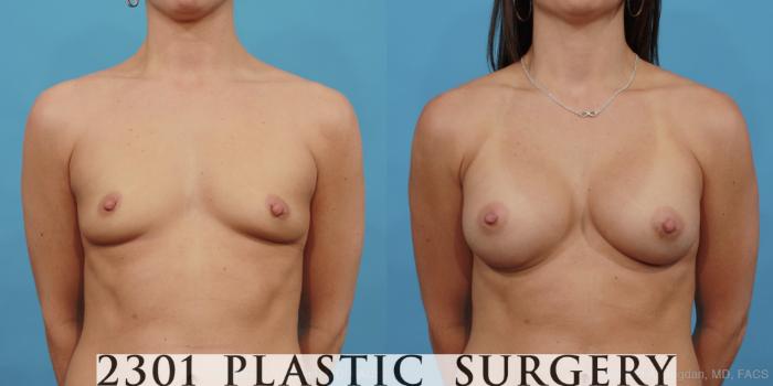 Before & After Silicone Implants Case 448 View #1 View in Fort Worth, Plano, & Frisco, Texas