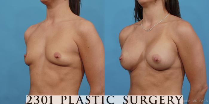 Before & After Silicone Implants Case 448 View #2 View in Fort Worth, Plano, & Frisco, Texas