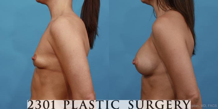 Before & After Silicone Implants Case 448 View #3 View in Fort Worth, Plano, & Frisco, Texas