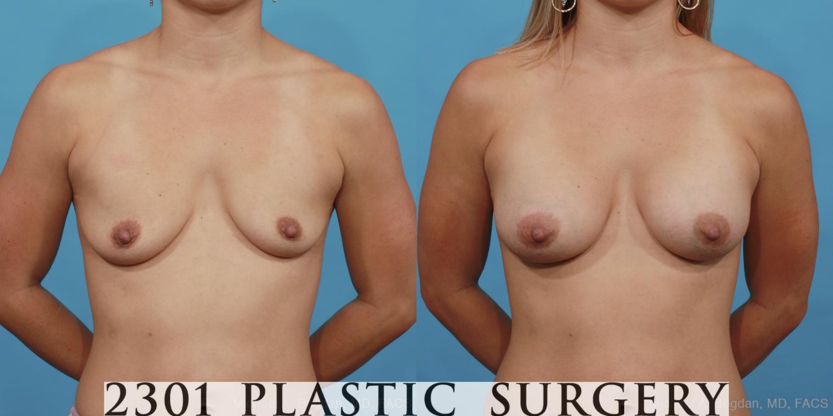 Before & After Silicone Implants Case 450 View #1 View in Fort Worth, Plano, & Frisco, Texas