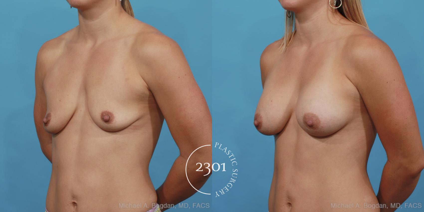 Before & After Silicone Implants Case 450 View #2 View in Fort Worth, Plano, & Frisco, Texas