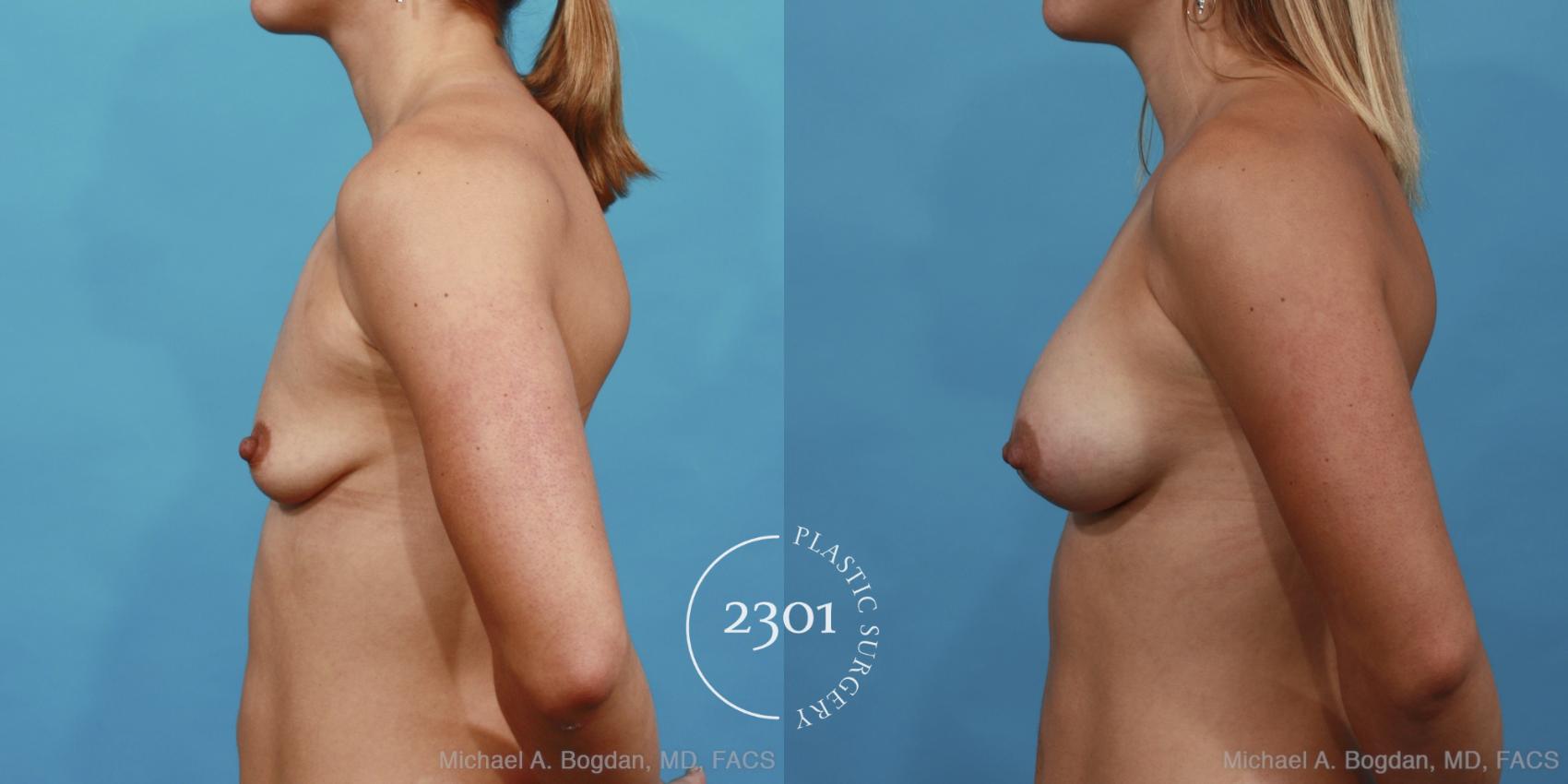 Before & After Silicone Implants Case 450 View #3 View in Fort Worth, Plano, & Frisco, Texas
