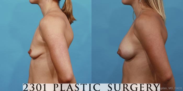 Before & After Silicone Implants Case 450 View #3 View in Fort Worth, Plano, & Frisco, Texas