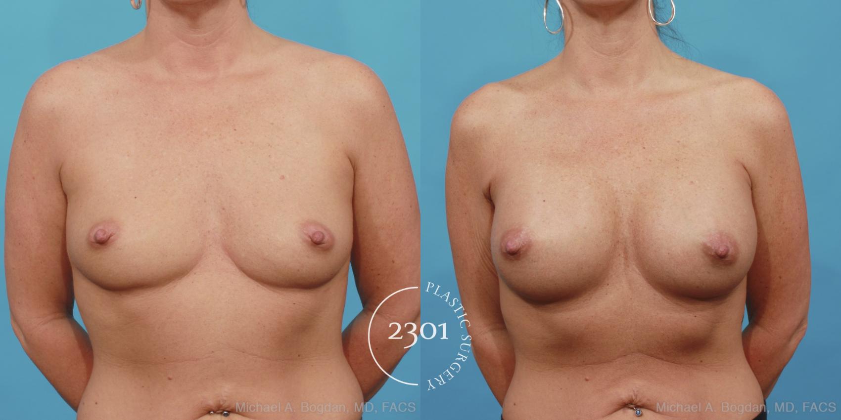 Before & After Silicone Implants Case 453 View #1 View in Fort Worth, Plano, & Frisco, Texas