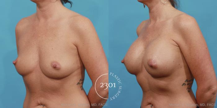 Before & After Silicone Implants Case 453 View #2 View in Fort Worth, Plano, & Frisco, Texas