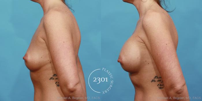 Before & After Silicone Implants Case 453 View #3 View in Fort Worth, Plano, & Frisco, Texas