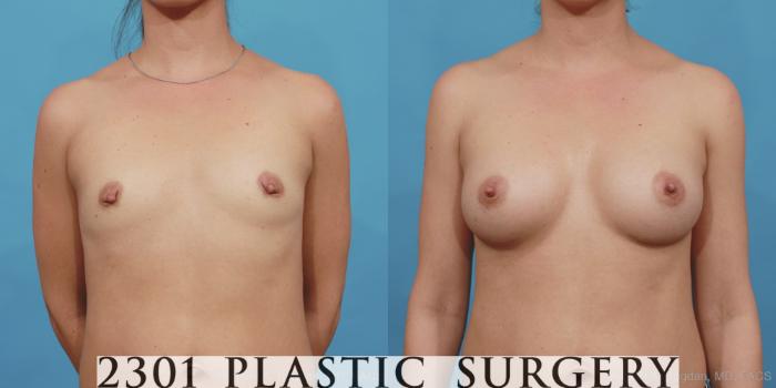 Before & After Silicone Implants Case 455 View #1 View in Fort Worth, Plano, & Frisco, Texas