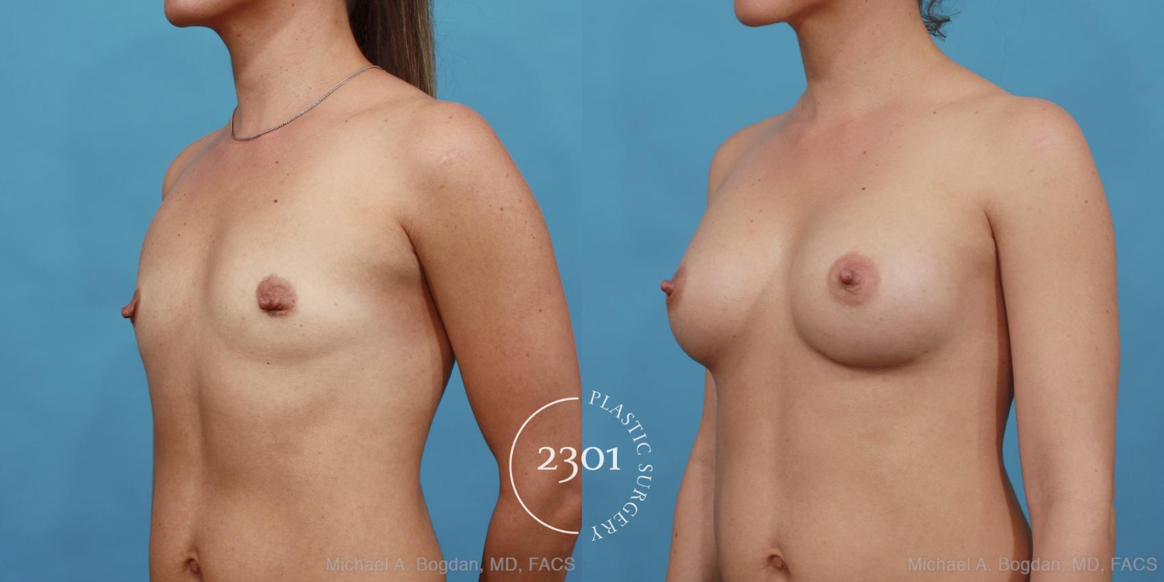 Before & After Silicone Implants Case 455 View #2 View in Fort Worth, Plano, & Frisco, Texas