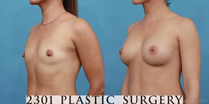 Before & After Silicone Implants Case 455 View #2 View in Fort Worth, Plano, & Frisco, Texas