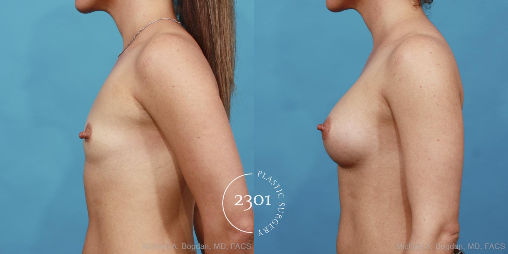 Before & After Silicone Implants Case 455 View #3 View in Fort Worth, Plano, & Frisco, Texas