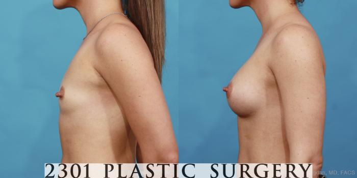 Before & After Silicone Implants Case 455 View #3 View in Fort Worth, Plano, & Frisco, Texas