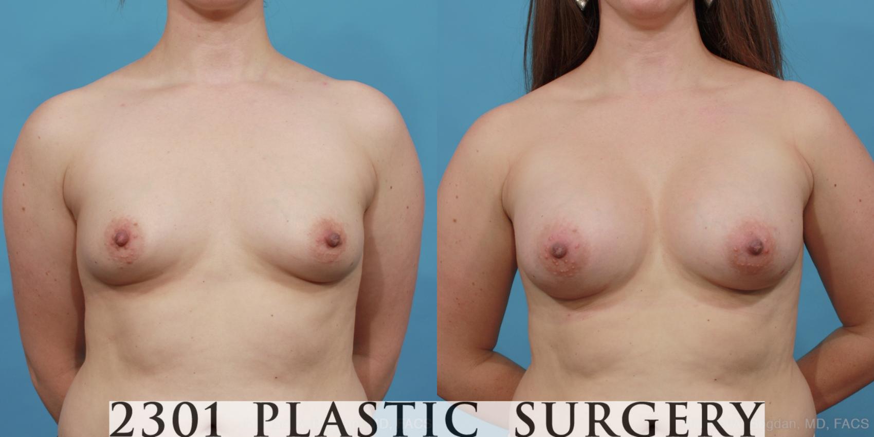 Before & After Silicone Implants Case 457 View #1 View in Fort Worth, Plano, & Frisco, Texas
