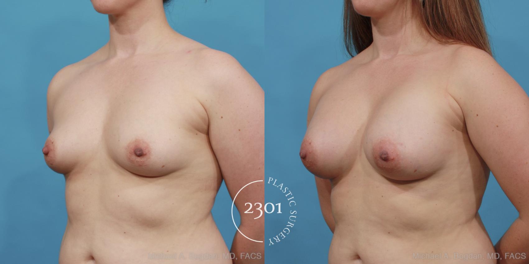 Before & After Silicone Implants Case 457 View #2 View in Fort Worth, Plano, & Frisco, Texas