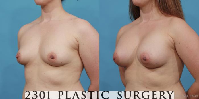 Before & After Breast Augmentation Case 457 View #2 View in Fort Worth, Plano, & Frisco, Texas