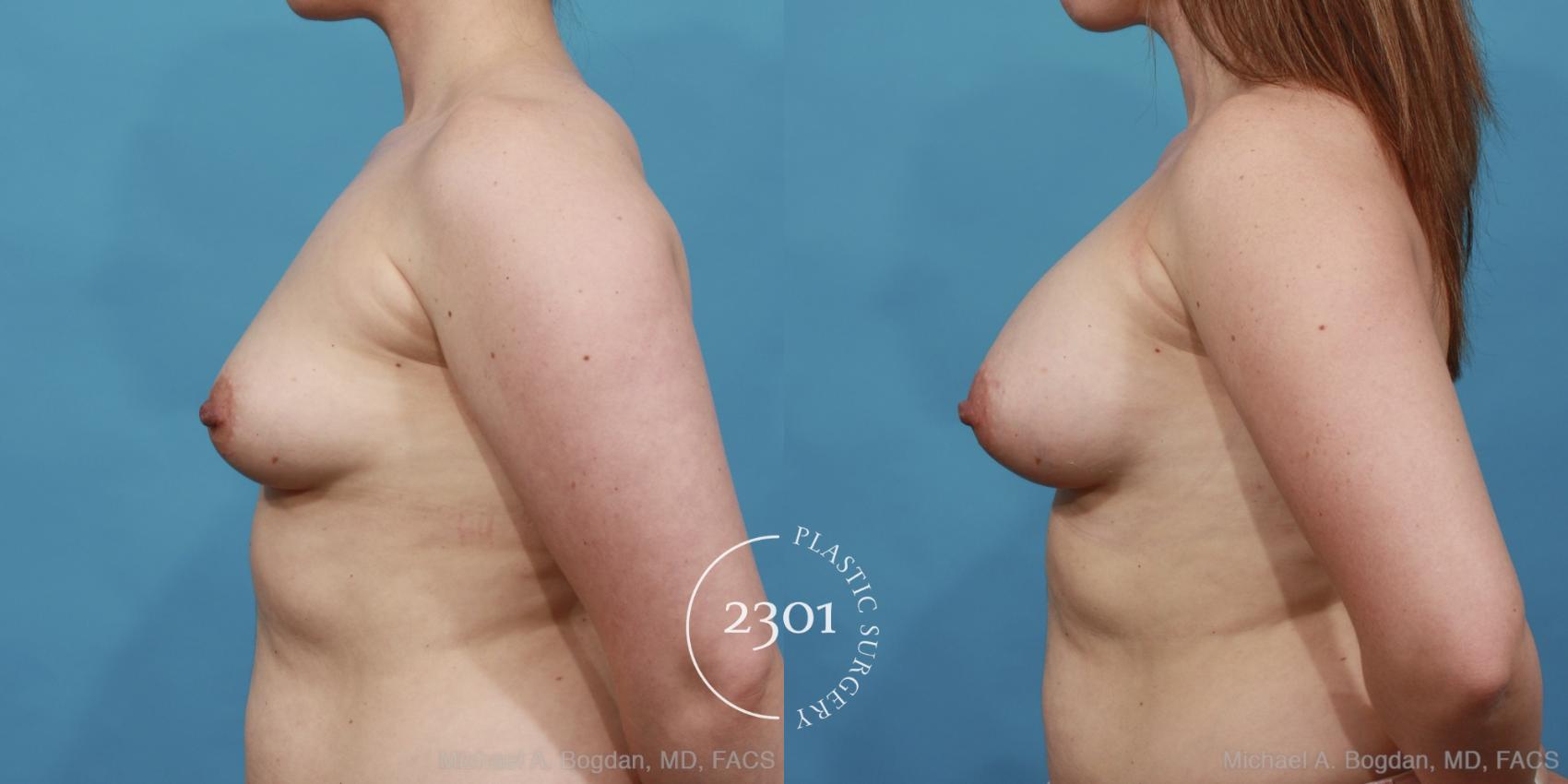Before & After Silicone Implants Case 457 View #3 View in Fort Worth, Plano, & Frisco, Texas