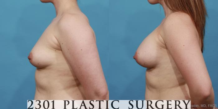 Before & After Silicone Implants Case 457 View #3 View in Fort Worth, Plano, & Frisco, Texas