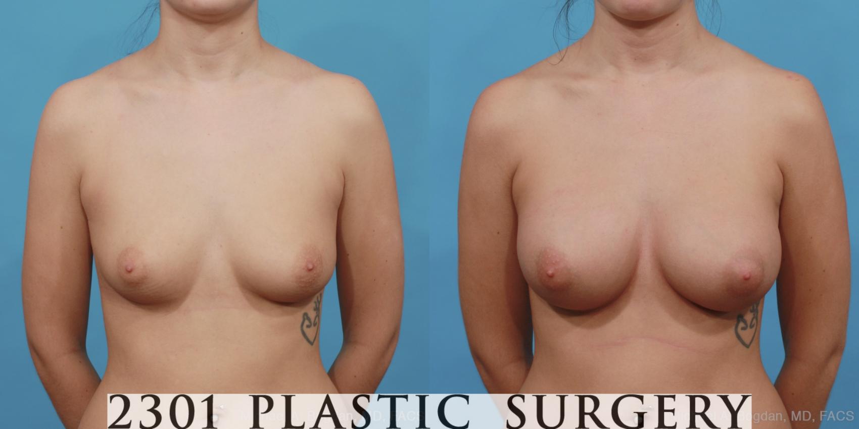 Before & After Silicone Implants Case 467 View #1 View in Fort Worth, Plano, & Frisco, Texas