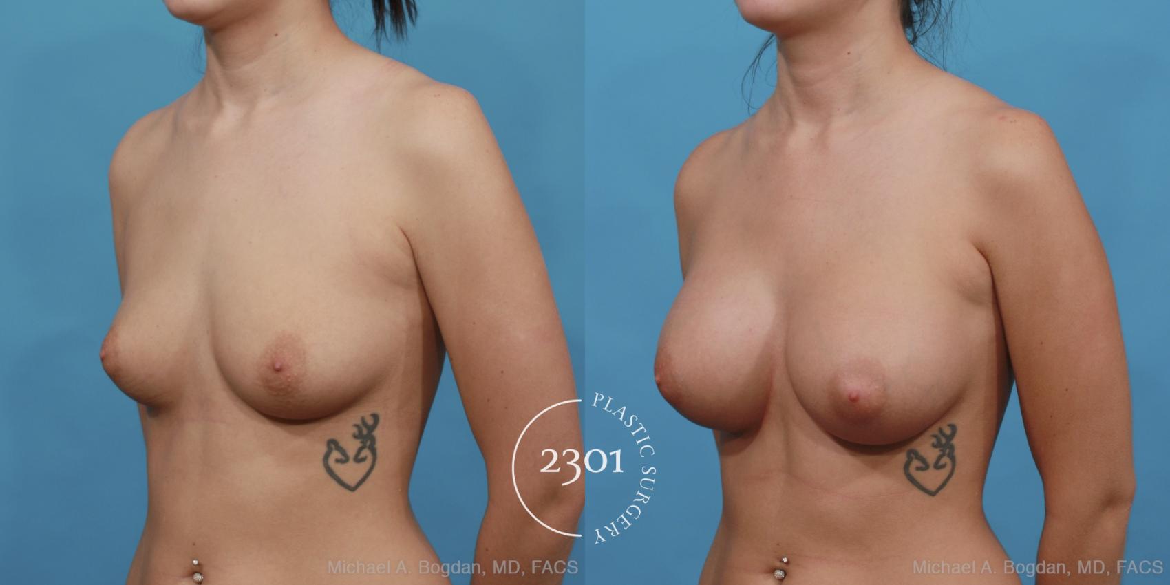 Before & After Silicone Implants Case 467 View #2 View in Fort Worth, Plano, & Frisco, Texas